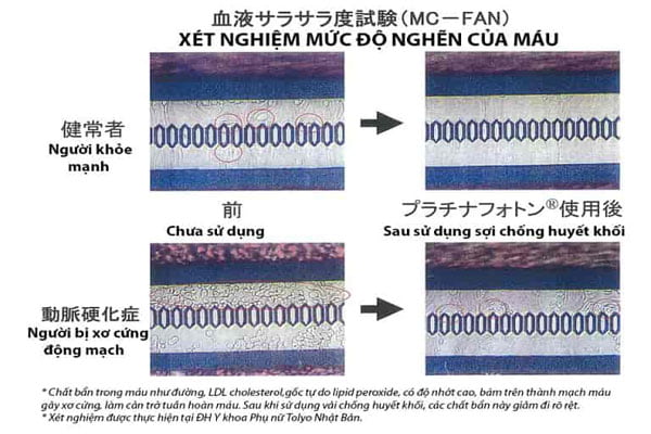 dau-hieu-tac-nghen-mach-mau-nao-tatnanosleepdays